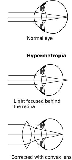 Hypermetropia long-sightedness