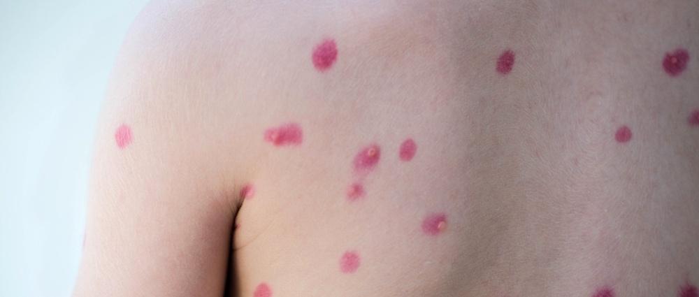 Chickenpox