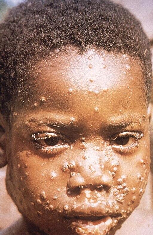 Photo of a child with Monkeypox