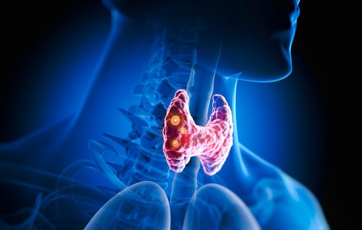 Underactive thyroid gland