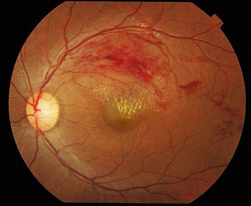 Retinal vein occlusions