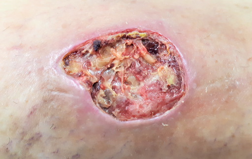 Varicose ulcer