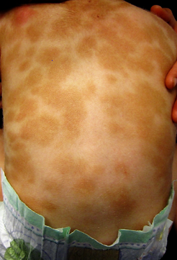 Urticaria Pigmentosa