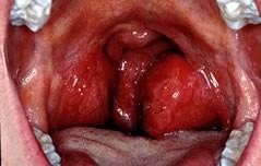 Swollen tonsils