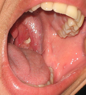 Tonsil stones
