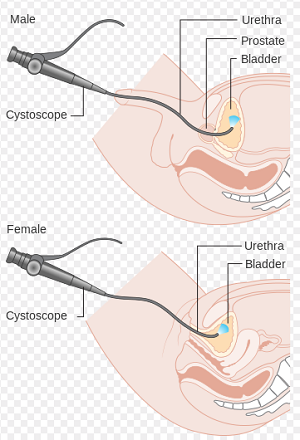 Cystoscopy: male and female