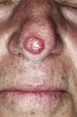 Basal cell carcinoma - nodular type