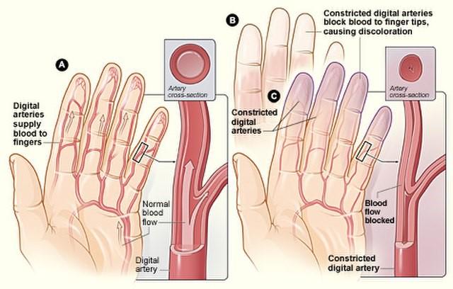 Raynaud's phenomenon