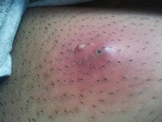 Five day-old abscess