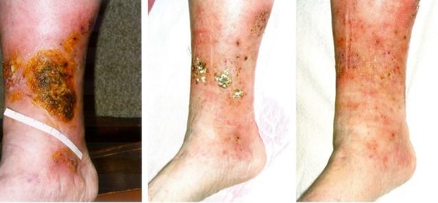 Varicose eczema